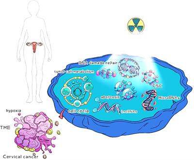 Review of possible mechanisms of radiotherapy resistance in cervical cancer